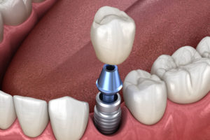 A Dental Implant In Your Mouth