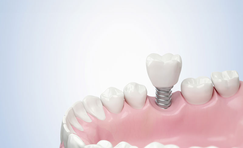 Close-up of a dental implant model showing a white tooth and pink gums, illustrating the integration of a dental implant into the jaw for medical education.